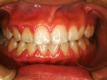 歯周治療写真